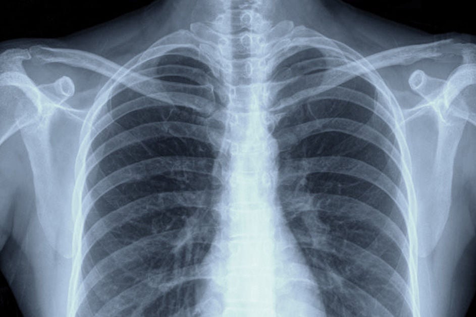  X-ray of a man's chest, displaying the lungs and heart for medical examination.