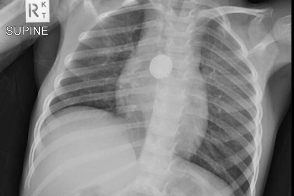 Chest X-ray depicting a child with a button battery present within the chest bone.