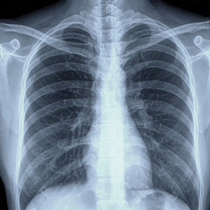 X-ray of a man's chest, displaying the lungs and heart for medical examination.